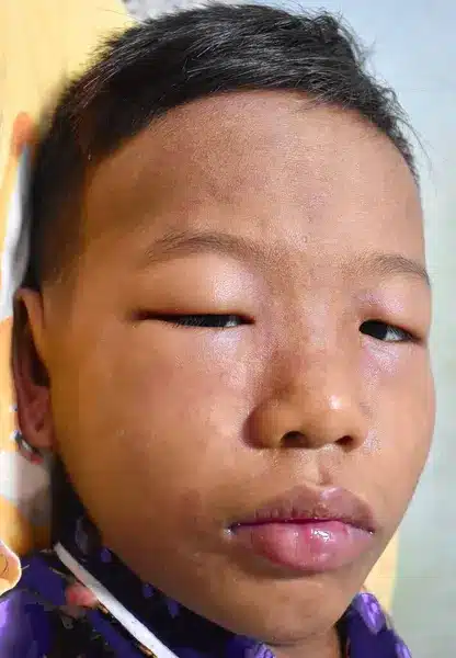 oedème de Quincke sur un enfant