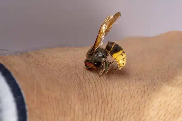 piqûre de frelon sur une main