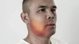 réaction allergique cutanée