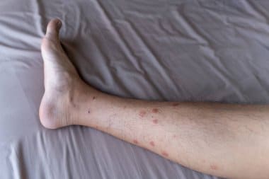 traiter les punaises de lit à Pierrefitte