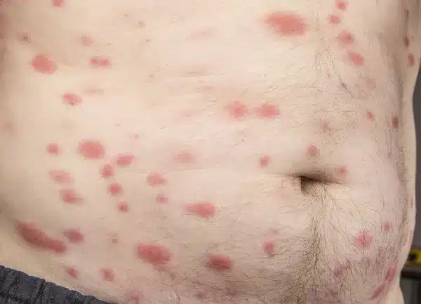 traiter les punaises de lit à noisy le sec